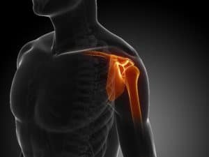 Shoulder X-Ray Illustration for Shoulder Replacement Patients