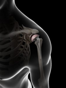 Shoulder Illustration after Total Shoulder Replacement 