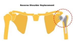 Reverse Total Shoulder Replacement for Columbus & Grove City, OH patients