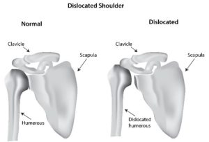Dislocated Shoulder Infographic