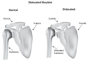 Dislocated Shoulder Infographic Chillicothe, OH