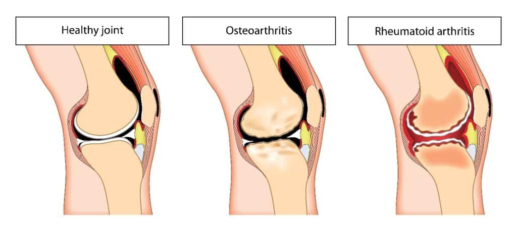 Knee Arthritis Types