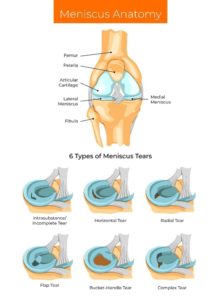 Meniscus Anatomy Infographic