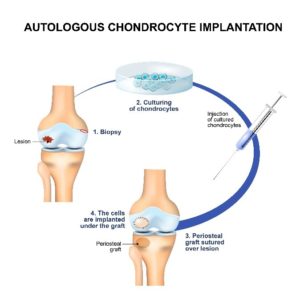 Knee Cartilage Transplants for Columbus & Grove City, OH patients