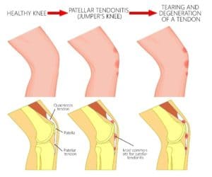 Patella (Kneecap) Tendonitis Infographic