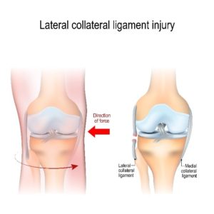 Collateral Ligament (MCL/ LCL) Injury Infographic 