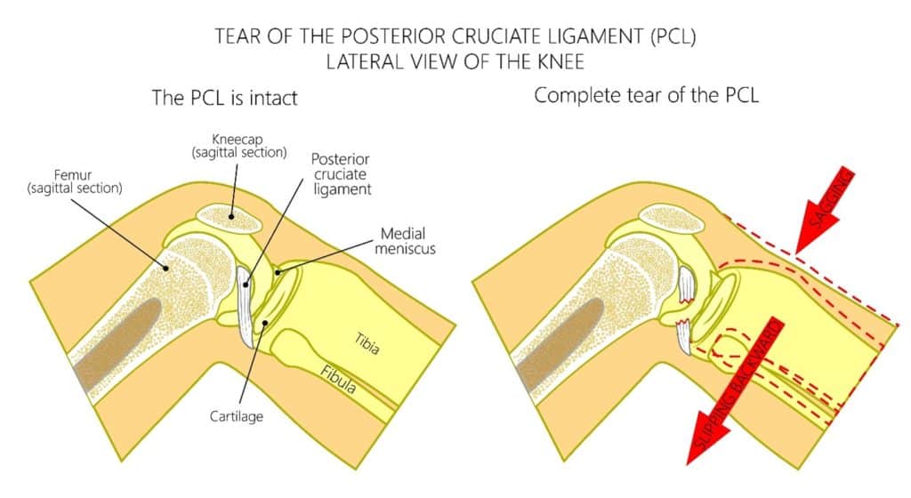 Posterior Cruciate Ligament (PCL) Injury: Symptoms & Treatment