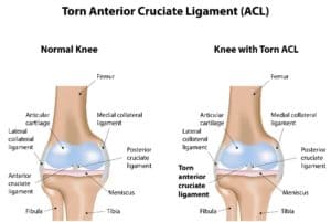 Comparing a healthy knee with a knee with a torn ACL