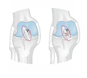 ACL Repair for Columbus & Grove City, OH patients