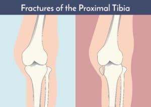 Shinbone fracture treatment for Columbus & Grove City, OH patients