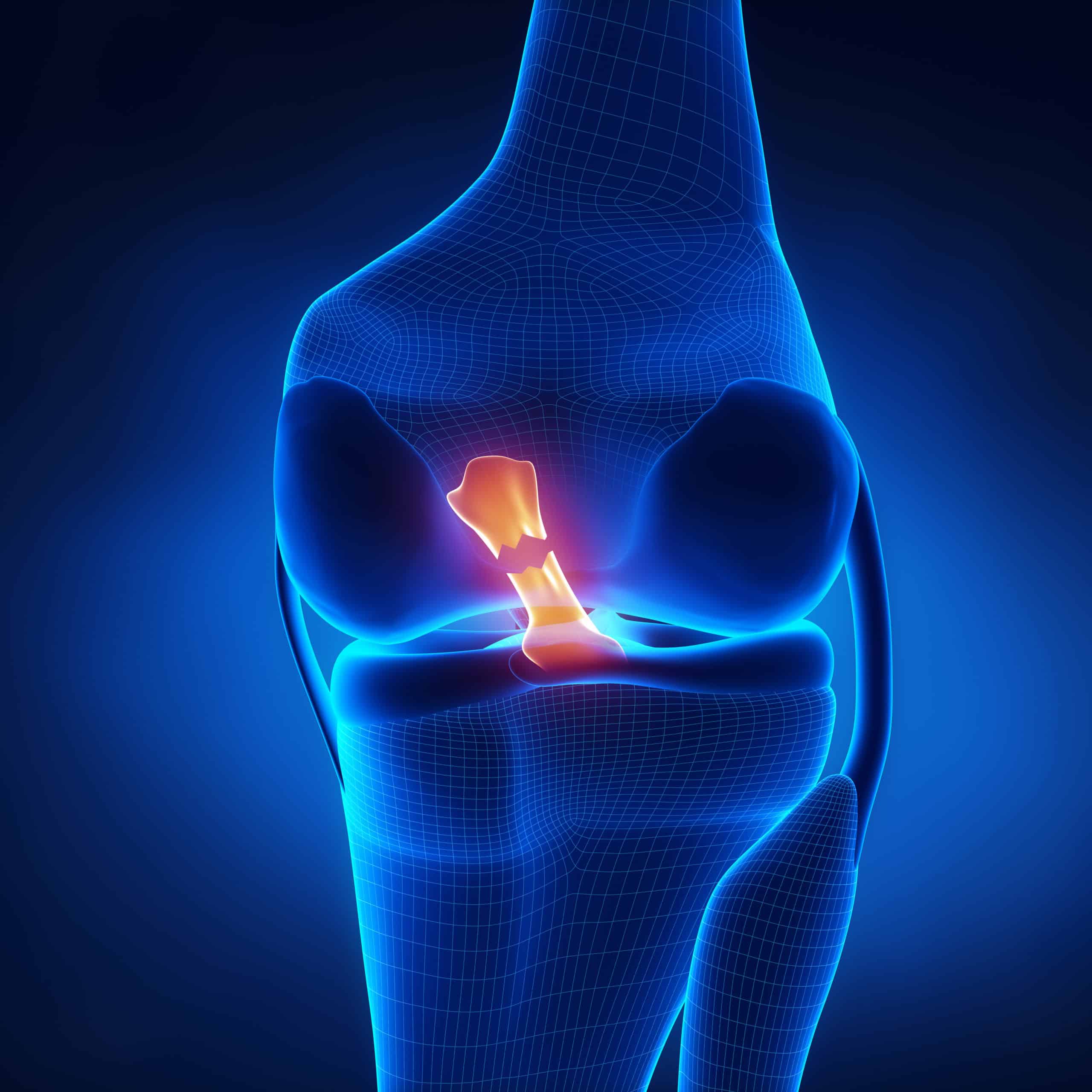 Knee Ligament Injury Treatment