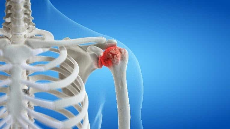 Shoulder Arthritis Treatment for Columbus & Grove City, OH