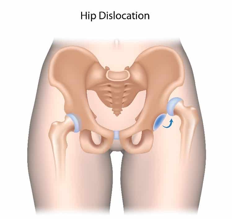 Dislocated Hip Treatment for Columbus & Grove City, OH