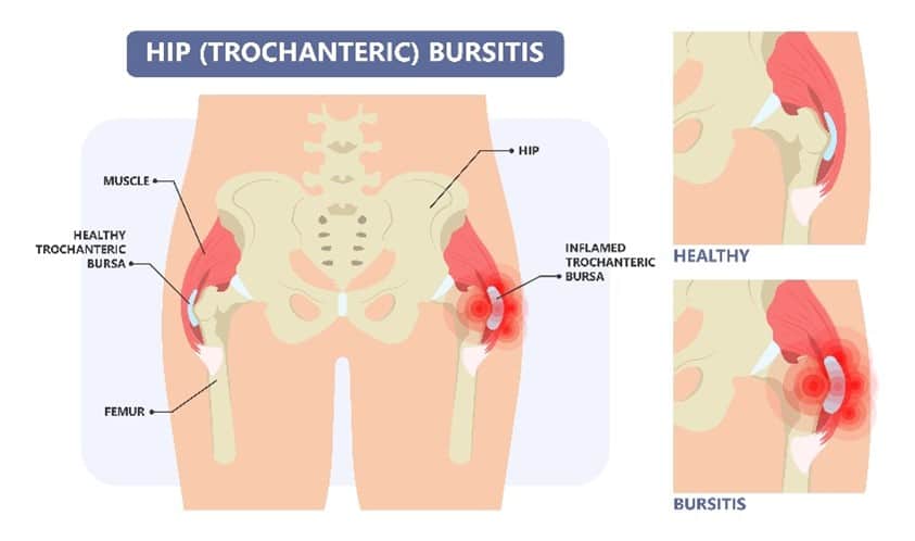 Hip Bursitis Infographic