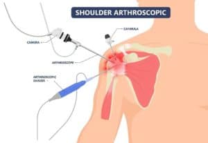 Arthroscopic Labral Tear Surgery Infographic