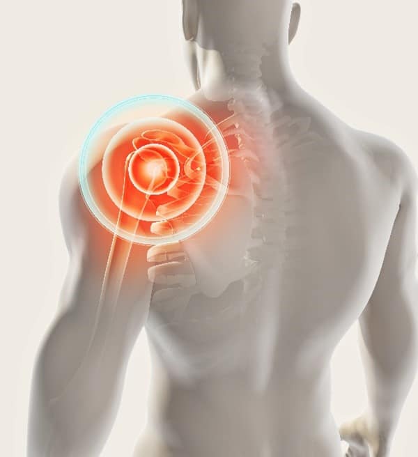 Frozen Shoulder Treatment Chillicothe, OH Adhesive Capsulitis Treatment