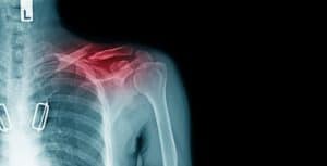 Clavicle Fracture Treatment for Columbus & Grove City, OH