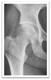 Patient Hip X-Ray