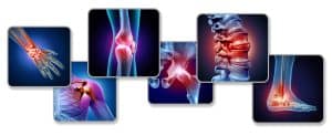 Arthritis Causing Shoulder, Hip, or Knee Pain