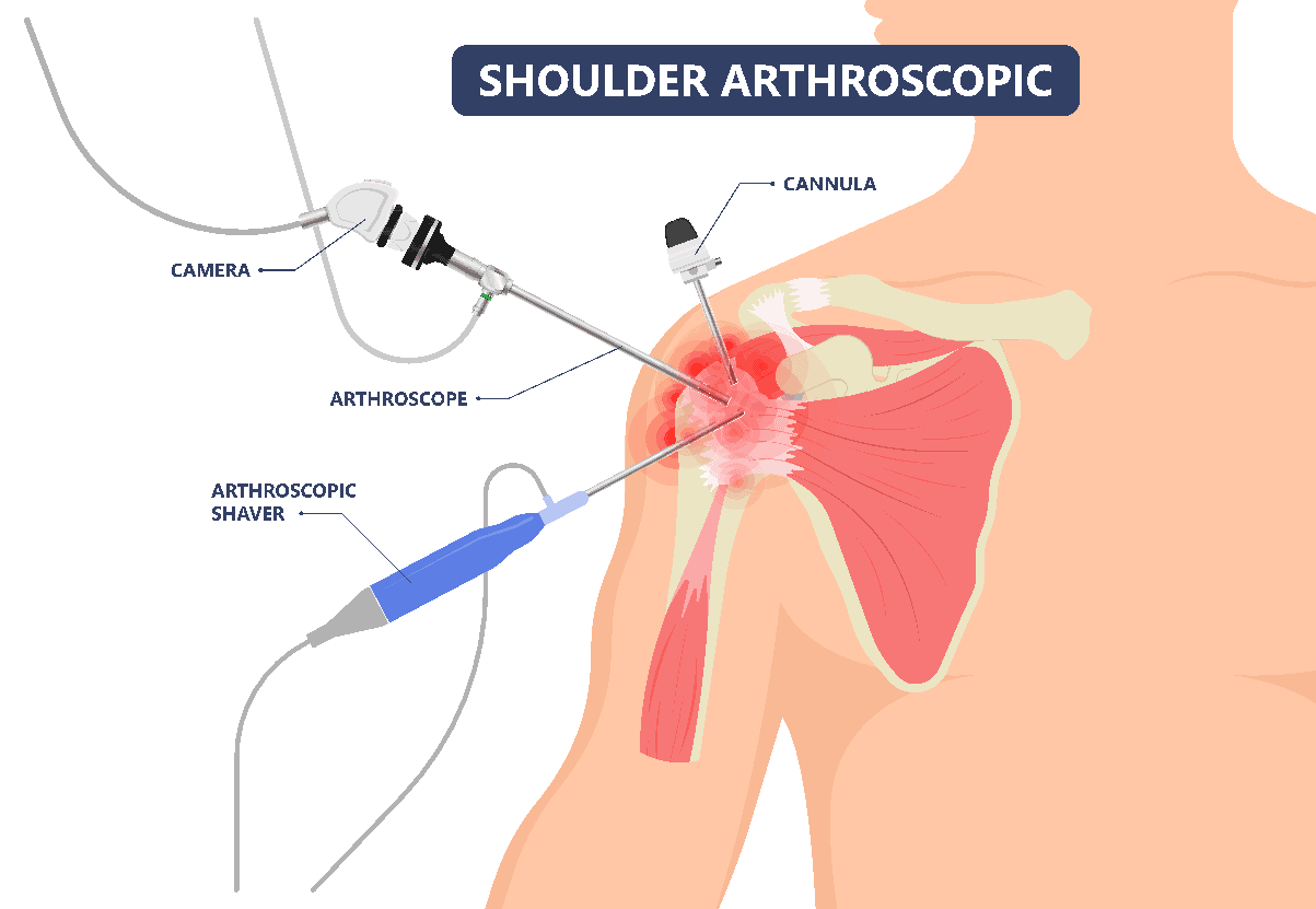 Shoulder Arthroscopy Chillicothe, OH Shoulder Pain Surgery Dr. Cohen