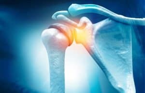 Rotator Cuff Injury Treatment Grove City, OH