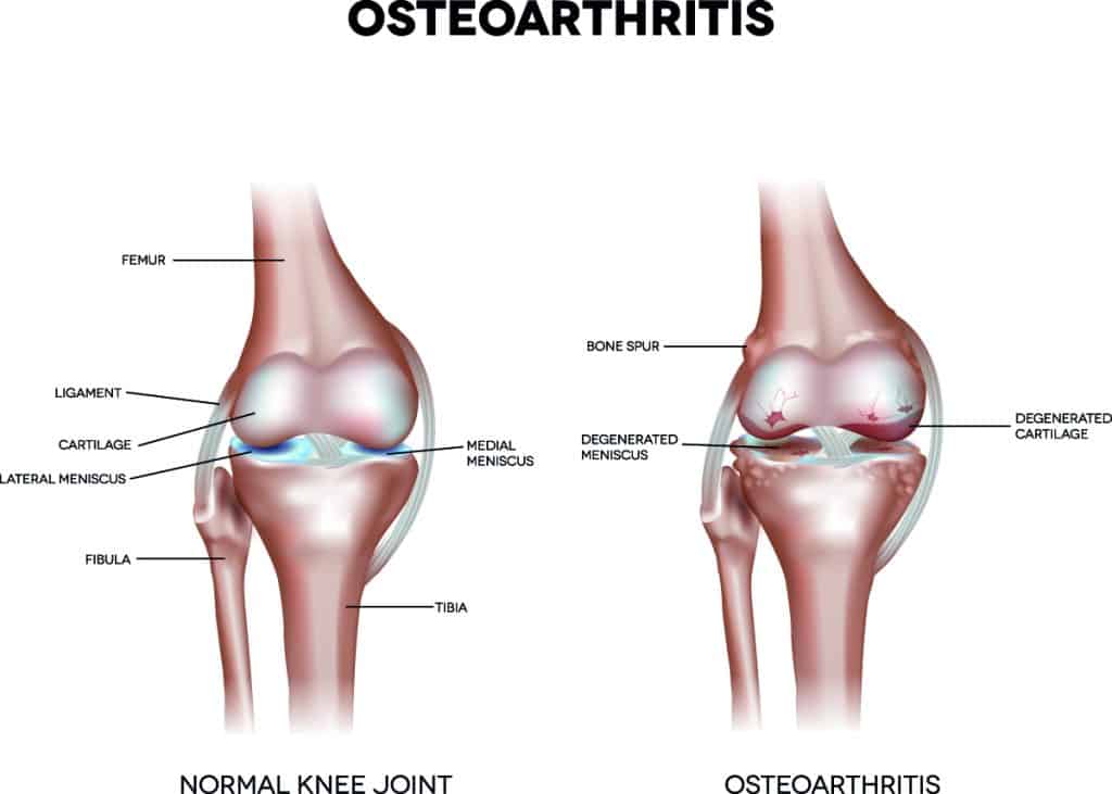 Osteoarthritis Surgery and Treatment Options Columbus, OH