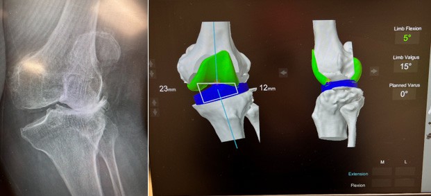 Valgus deformity