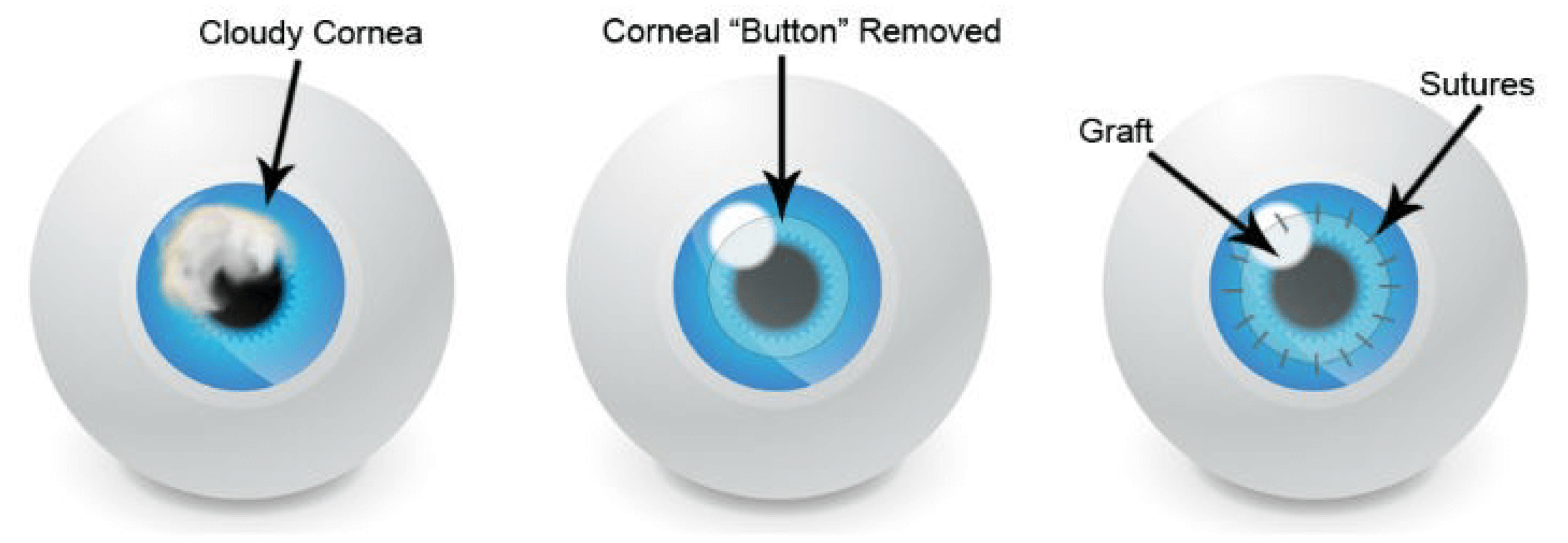 keratoconus corneal transplant