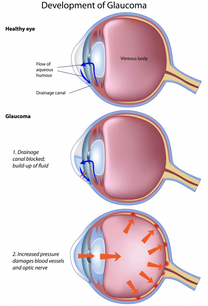 Glaucoma Surgery