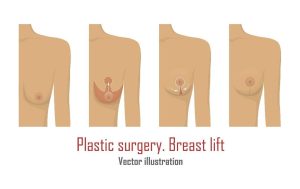 Choosing the Right Breast Implants for Your Body, Plastic Surgery located  in Roslyn Heights, NY