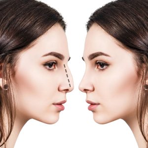 Rhinoplasty in Woodmere