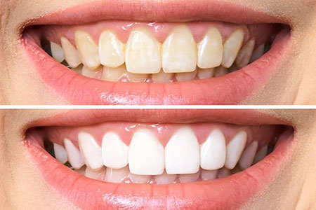 Teeth Whitening in Whitehouse, OH