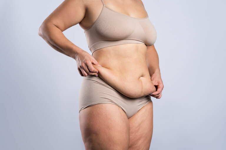 Woman holds loose skin in her abdomen and hips after bariatric surgery