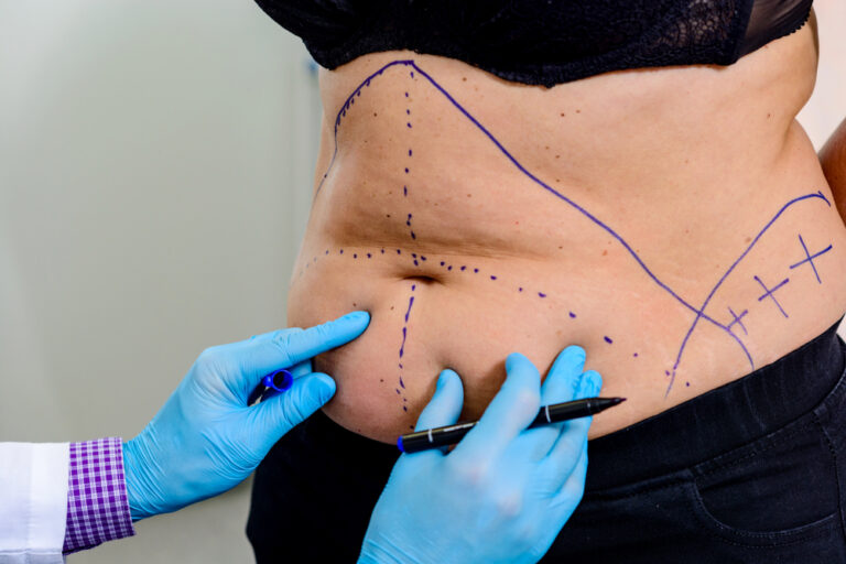 Doctor marks areas for fat removal during a tummy tuck