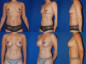 Mommy Makeover Mommy Makeover - combined tummy tuck and breast augmentation