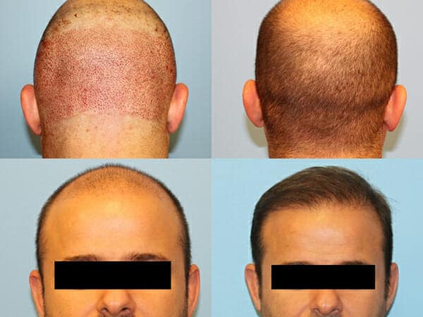 Neograft hair transplants New York City