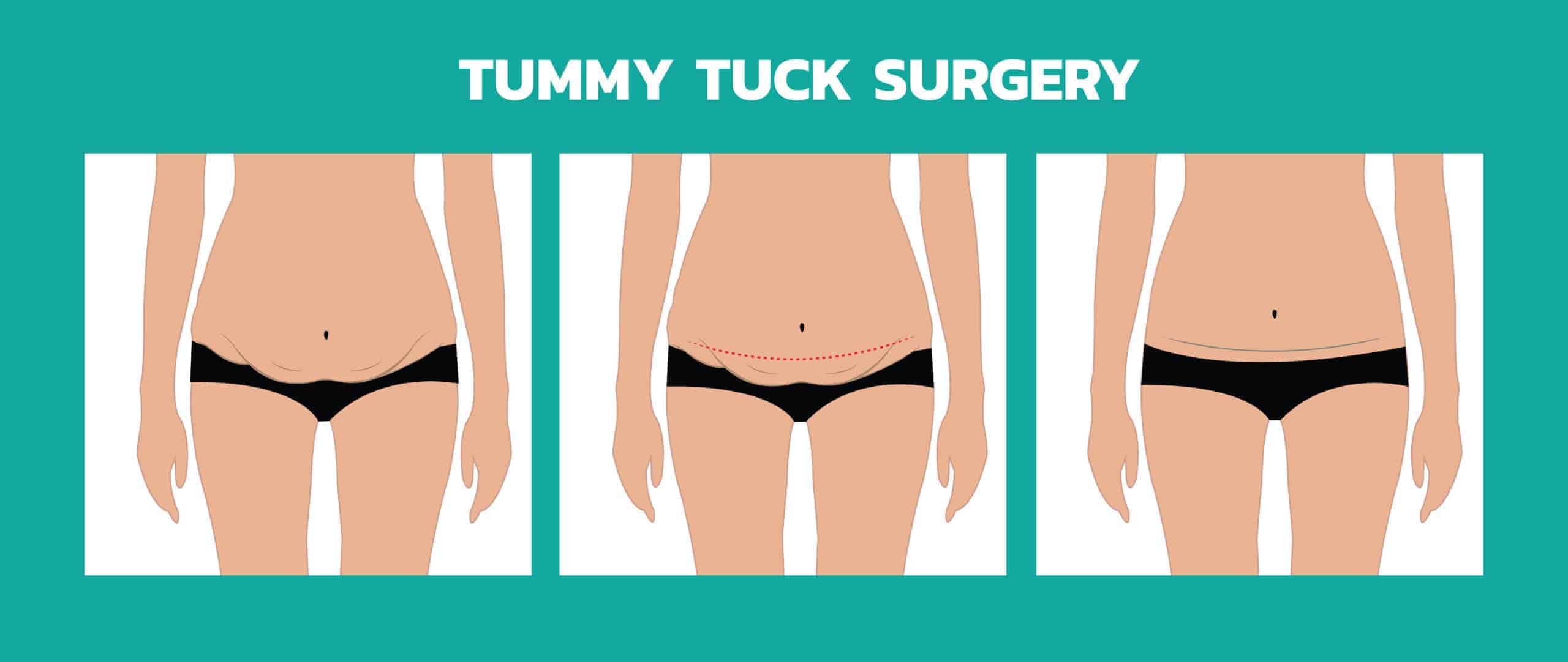 Mini Tummy Tuck vs. Full Tummy Tuck