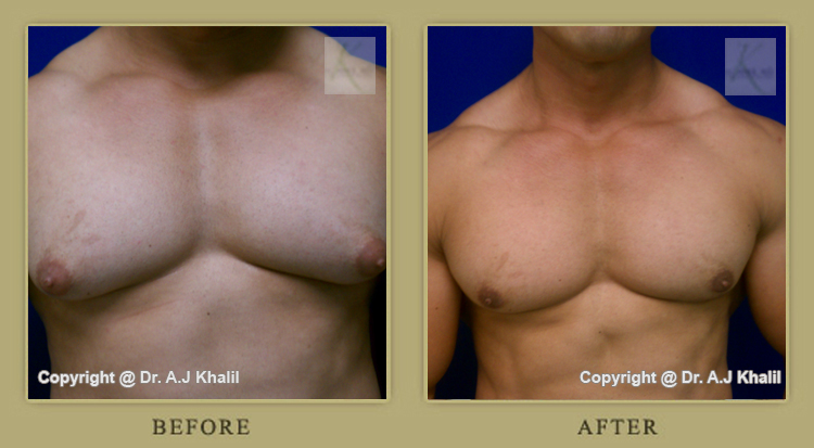 Los Angeles male breast reduction surgery