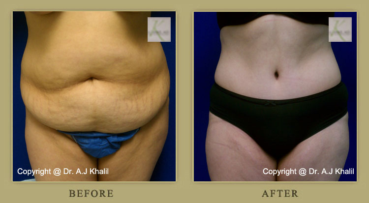 Tummy Tuck in Beverly Hills