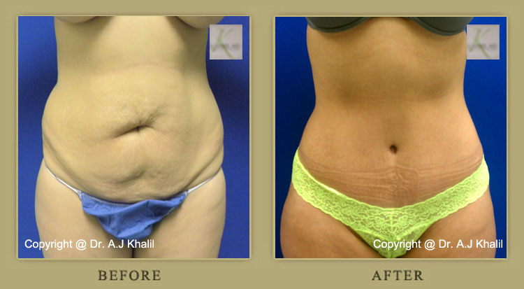 Tummy Tuck Revision - Beverly Hills Physicians