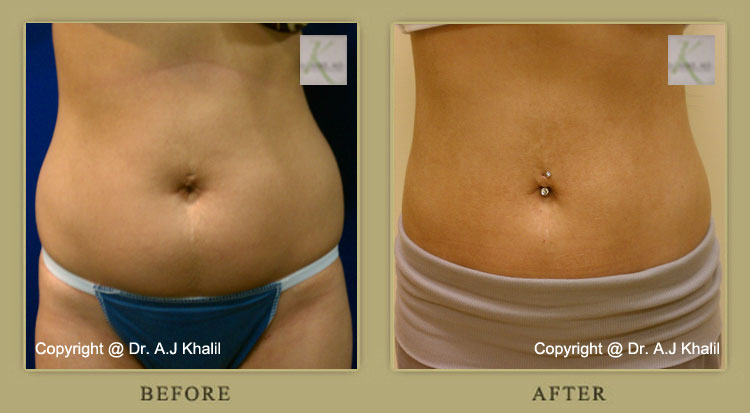 Patient before & after lipo in Beverly Hills