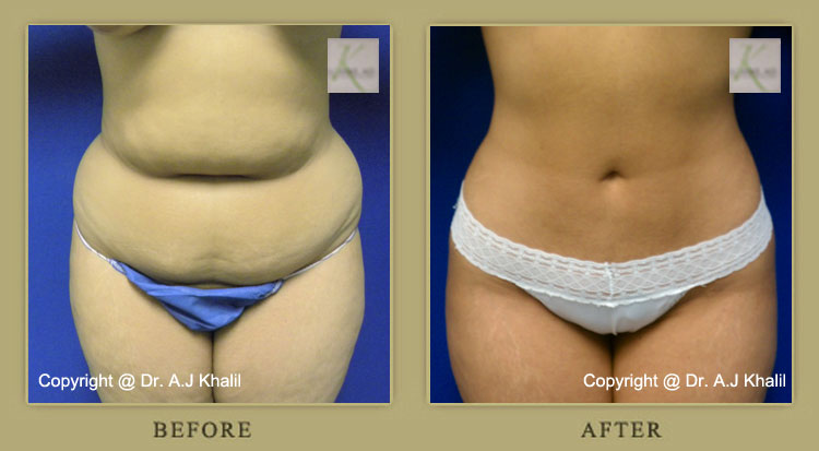 Beverly Hills Liposuction Results