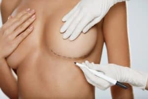 Breast Revision vs. Implant Removal Beverly Hills