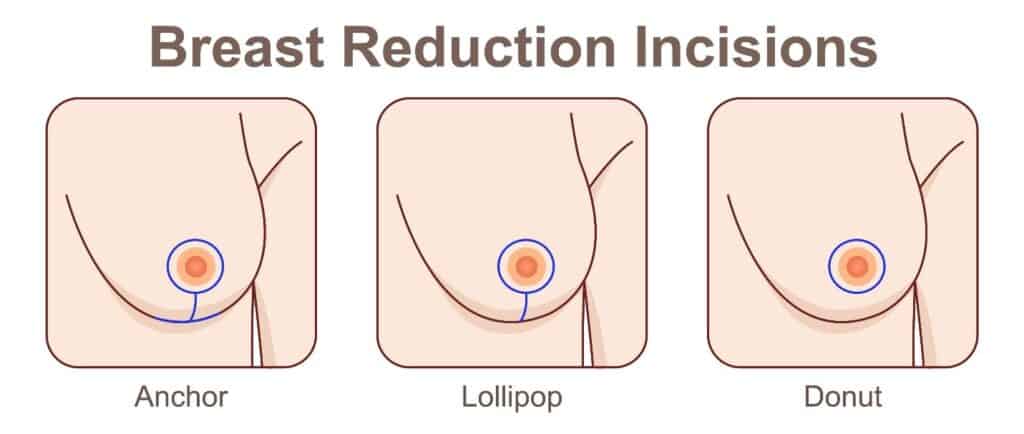 Breast Reduction incision