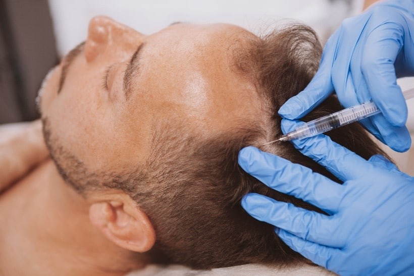 Platelet-Rich Hair Loss Treatment Beverly Hills, CA