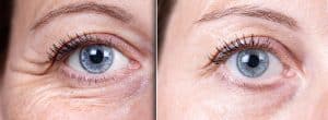 Lower blepharoplasty Beverly Hills