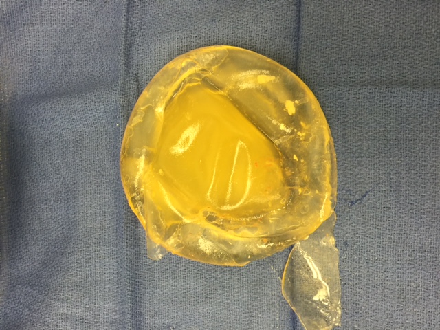breast implants