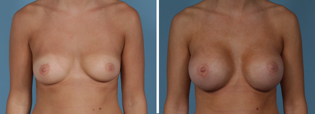 Breast Augmentation350 cc Moderate Plus Silicone Gel Implants