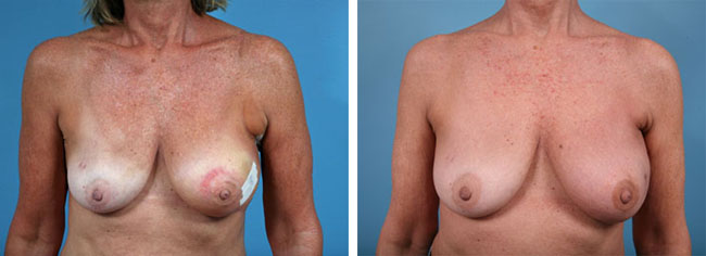 Latissimus Dorsi Flap Breast Reconstruction Chicago