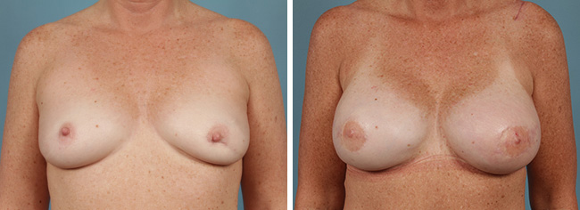 Latissimus Flap Breast Reconstruction Chicago